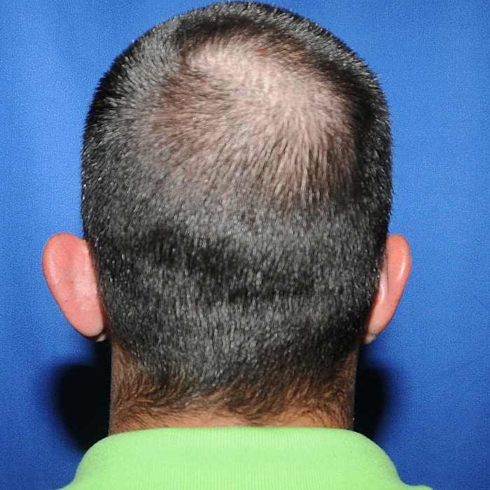 Otoplasty Before & After