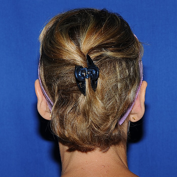 Otoplasty Before & After