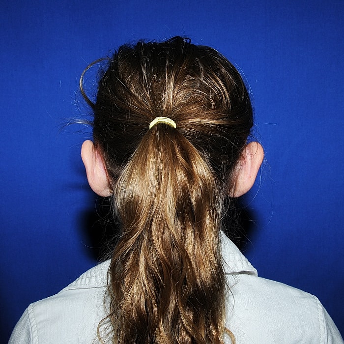 Otoplasty Before & After