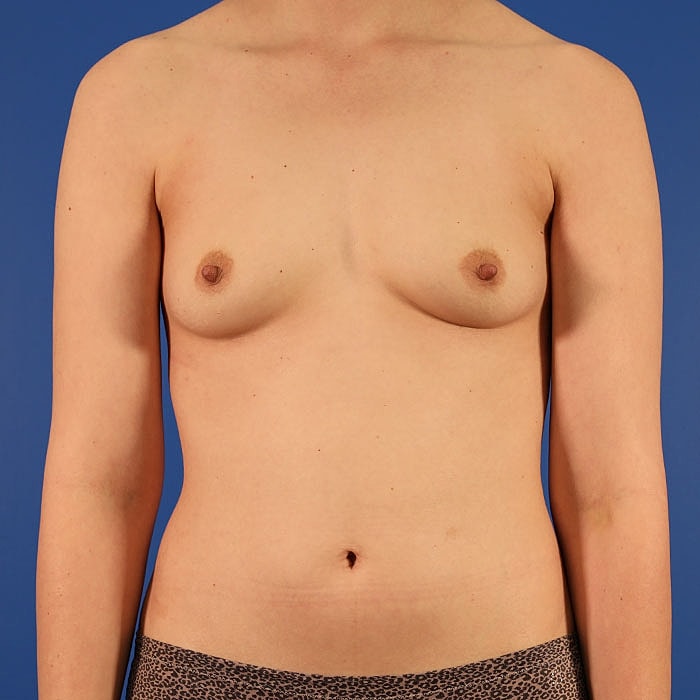 Implant Based Reconstruction Before & After