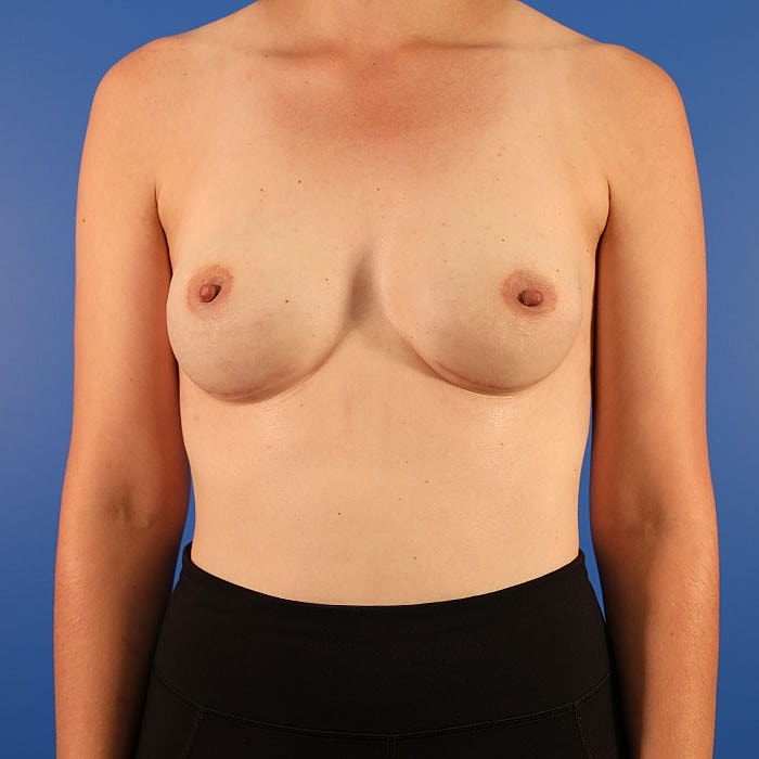 Implant Based Reconstruction Before & After