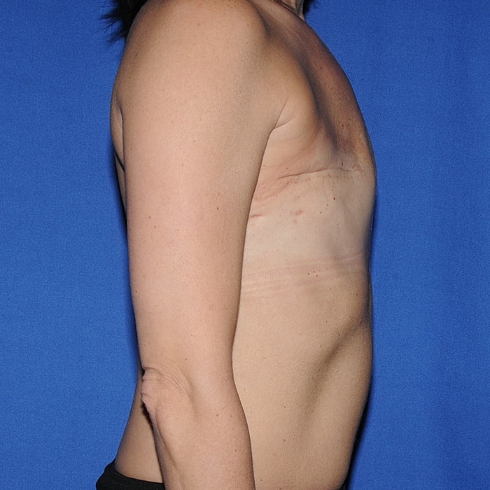 Implant Based Reconstruction Before & After