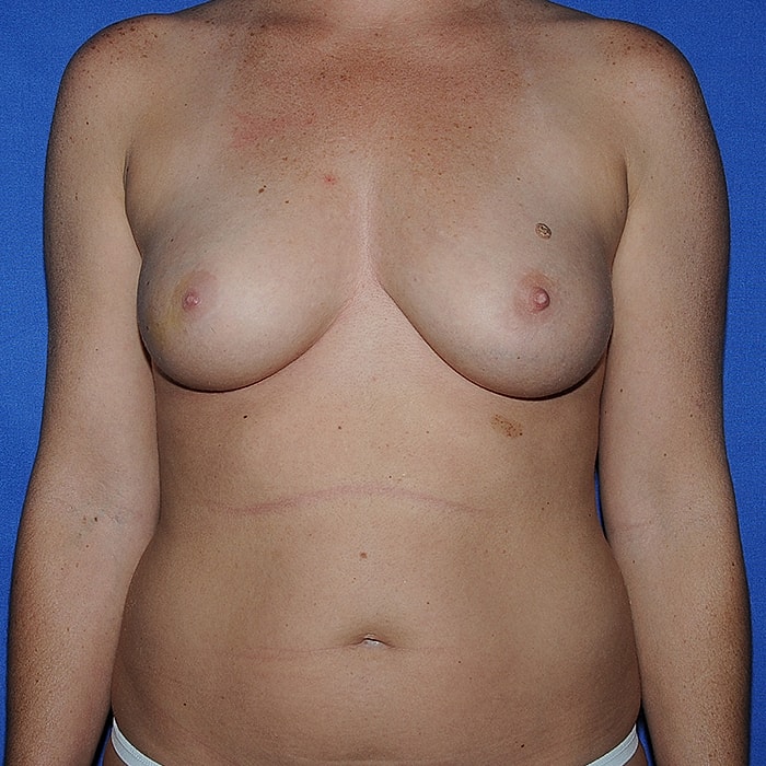 Implant Based Reconstruction Before & After