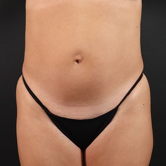 Abdominoplasty Before & After