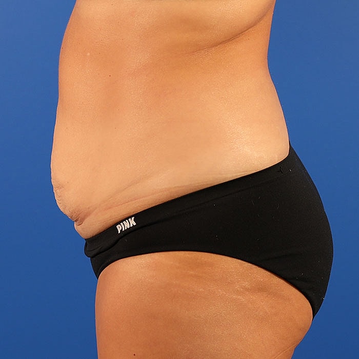 Abdominoplasty Before & After