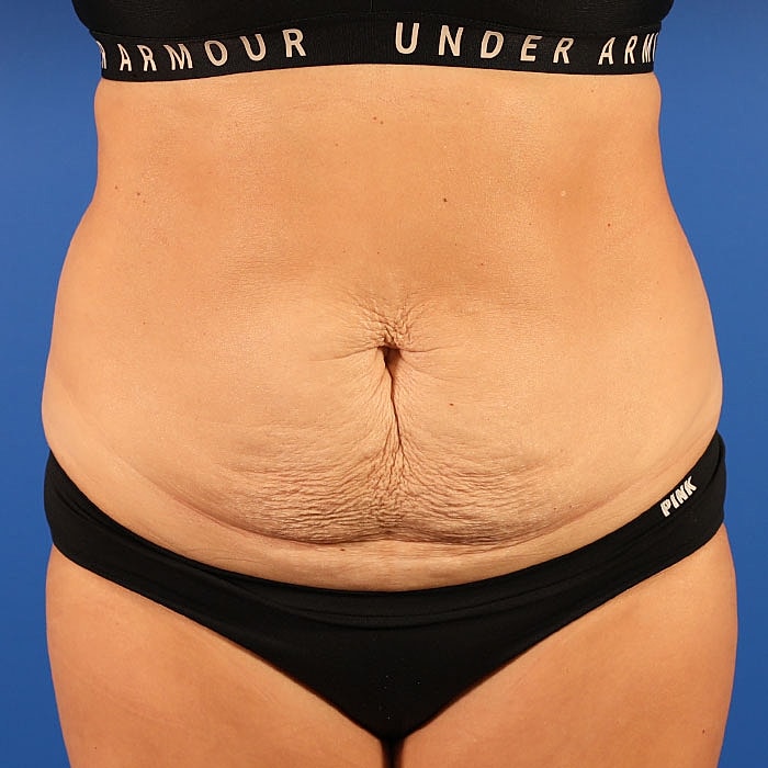 Abdominoplasty Before & After
