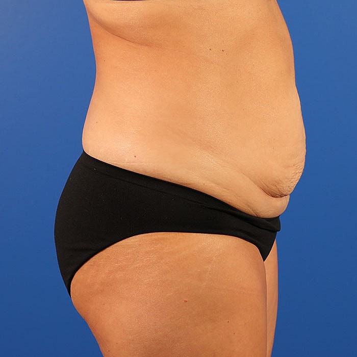 Abdominoplasty Before & After