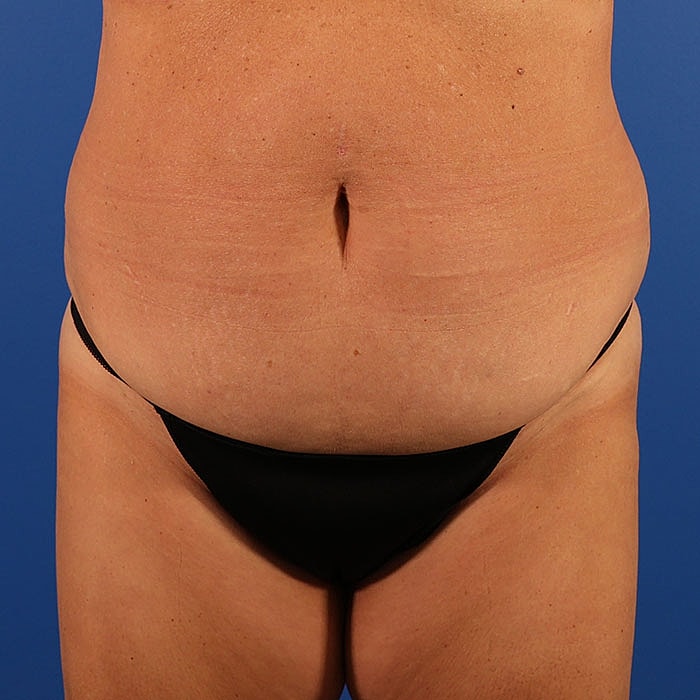 Abdominoplasty Before & After