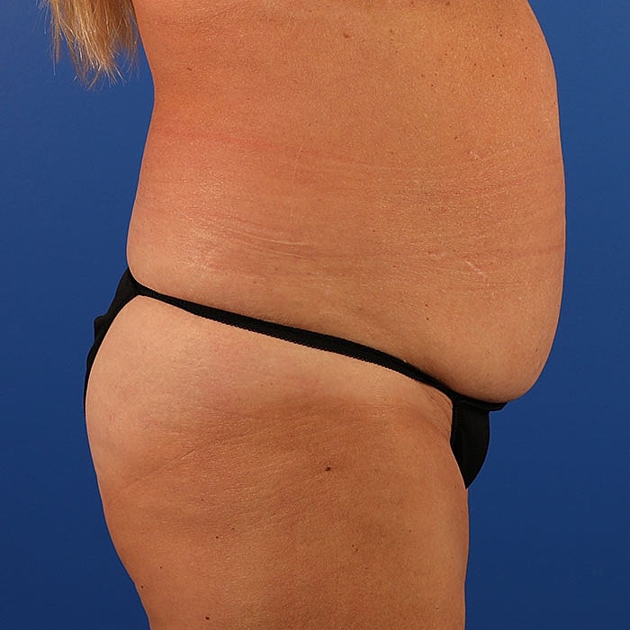 Abdominoplasty Before & After