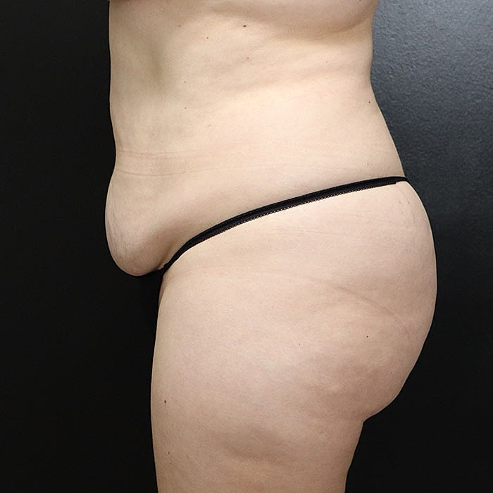 Abdominoplasty Before & After