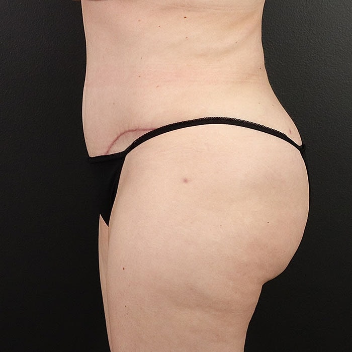 Abdominoplasty Before & After