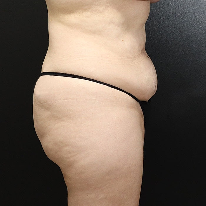 Abdominoplasty Before & After