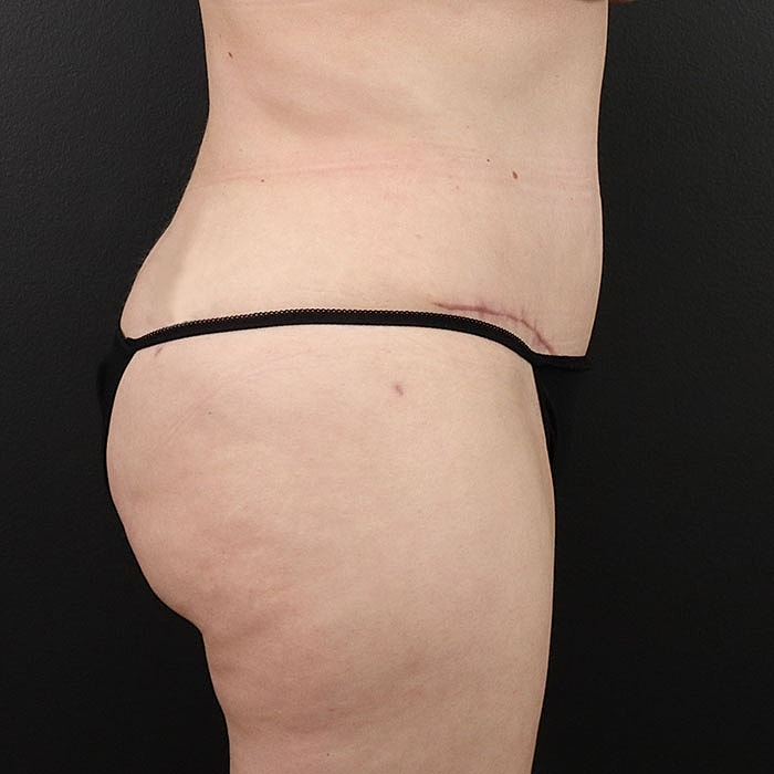 Abdominoplasty Before & After
