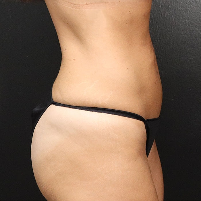 Abdominoplasty Before & After