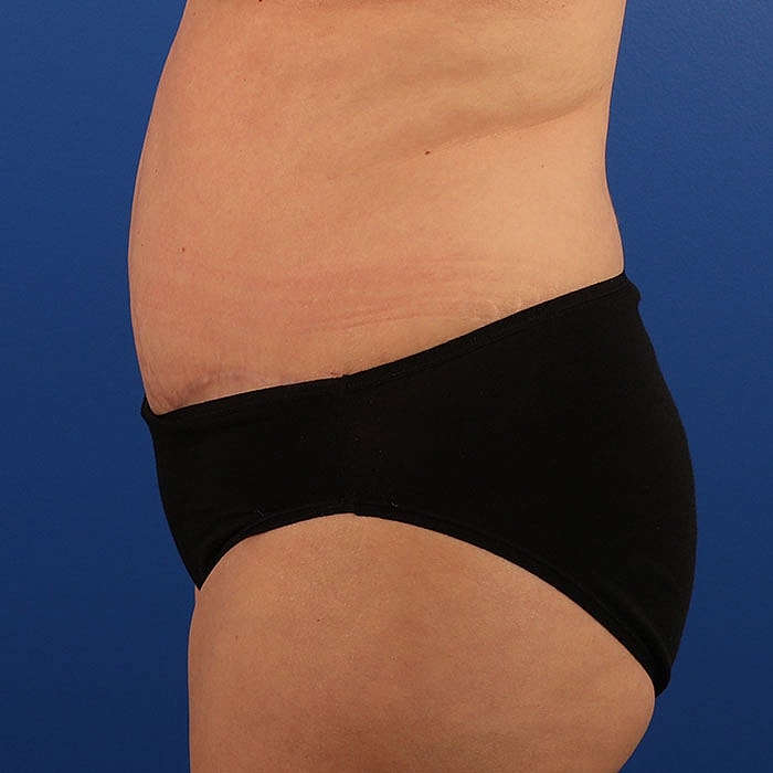 Abdominoplasty Before & After