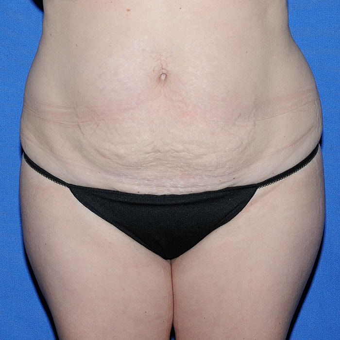 Abdominoplasty Before & After