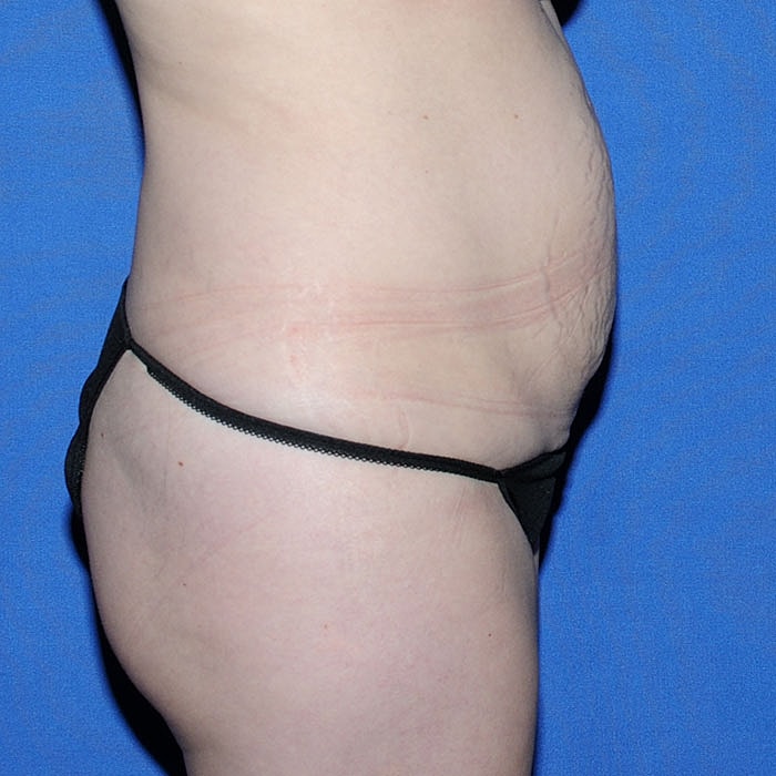 Abdominoplasty Before & After