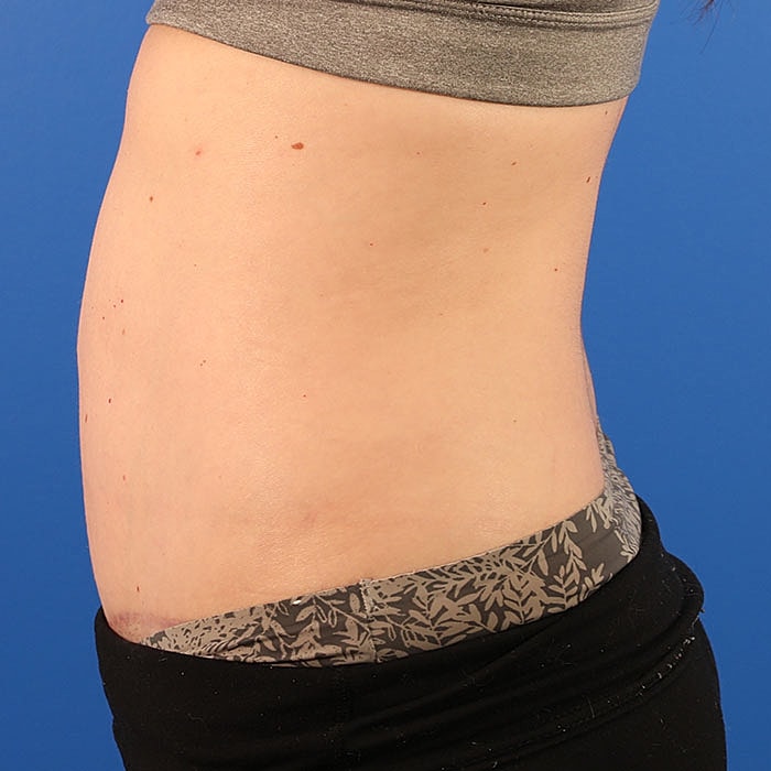 Abdominoplasty Before & After