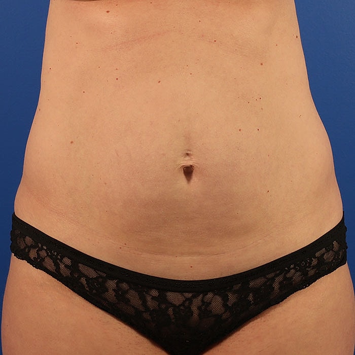 Abdominoplasty Before & After