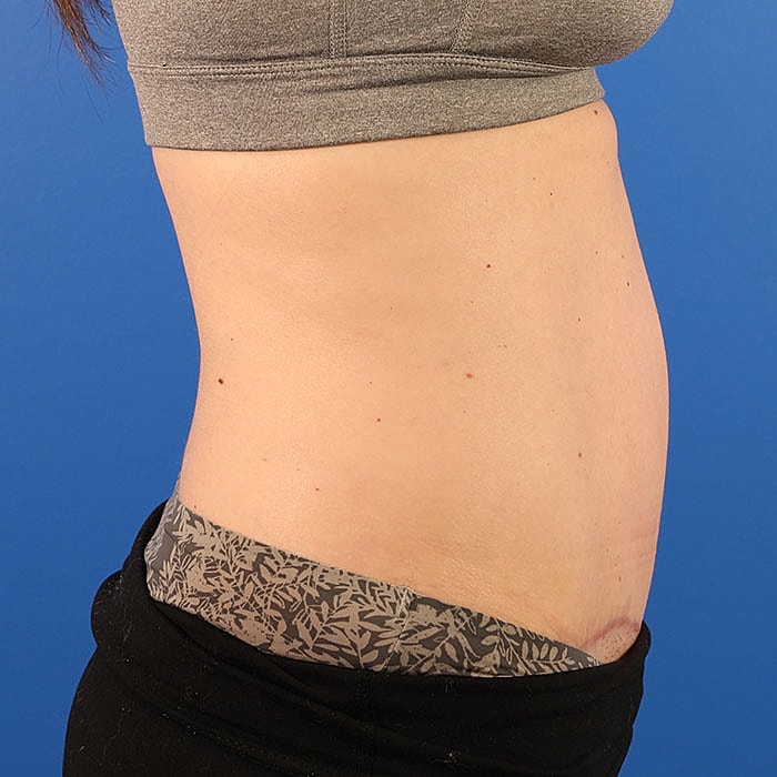 Abdominoplasty Before & After