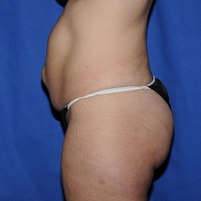 Abdominoplasty Before & After