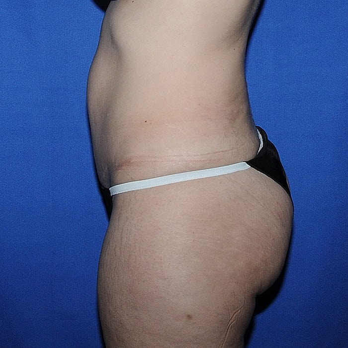 Abdominoplasty Before & After