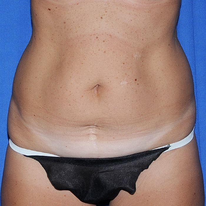 Abdominoplasty Before & After