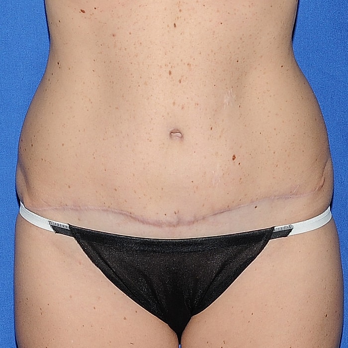 Abdominoplasty Before & After
