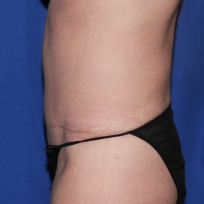 Abdominoplasty Before & After