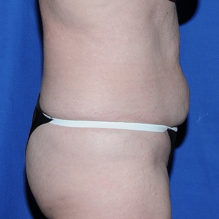 Abdominoplasty Before & After