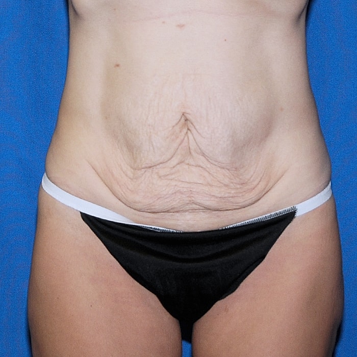 Abdominoplasty Before & After