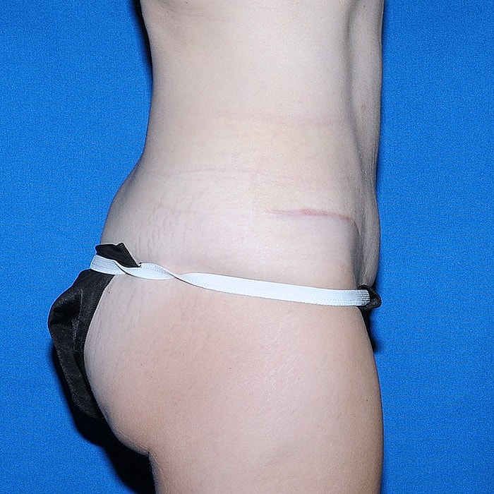 Abdominoplasty Before & After