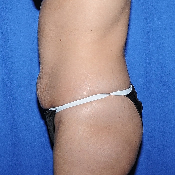 Abdominoplasty Before & After