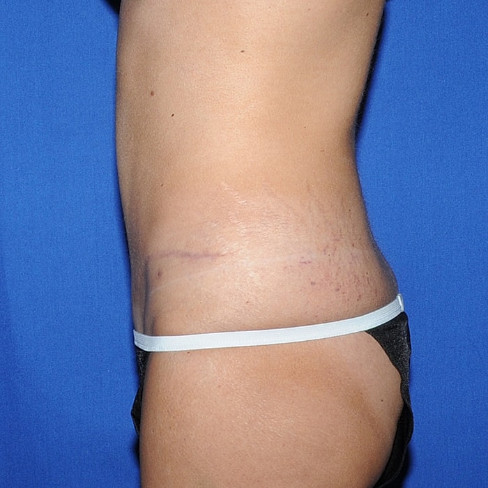 Abdominoplasty Before & After