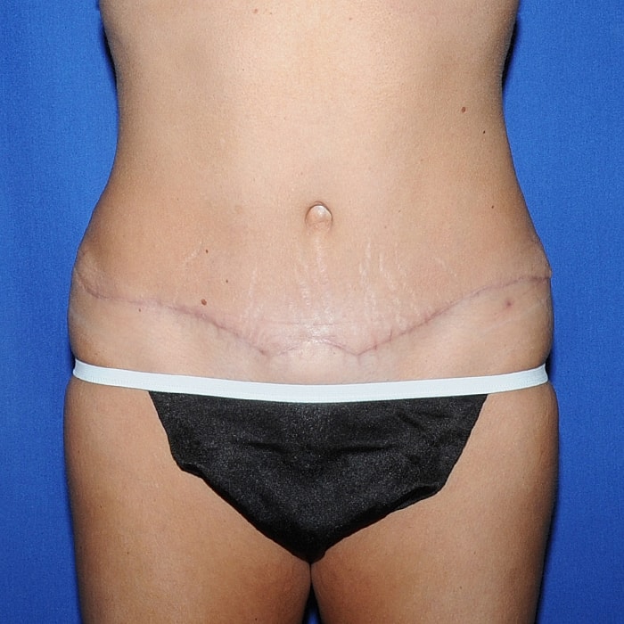 Abdominoplasty Before & After