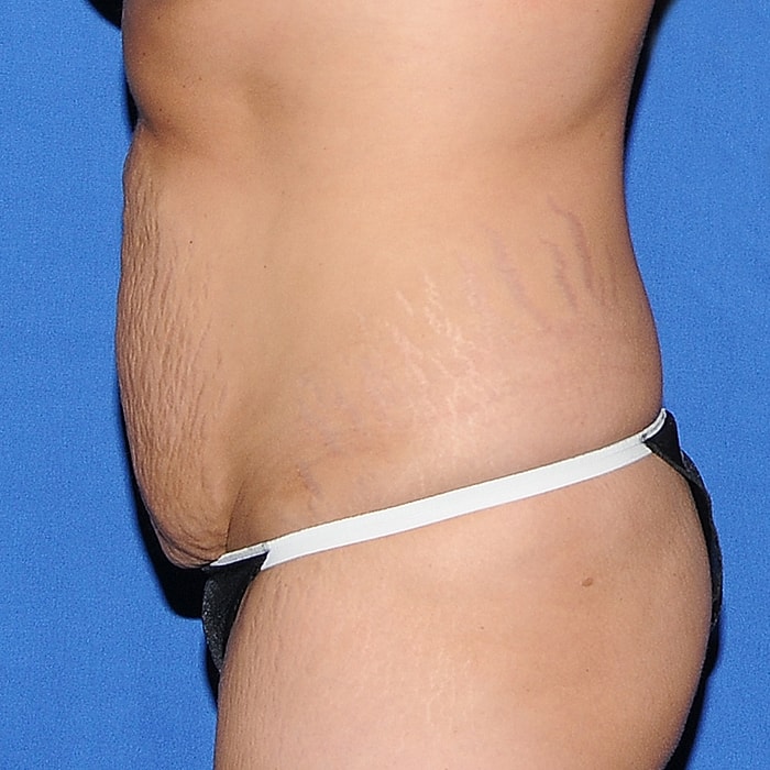 Abdominoplasty Before & After