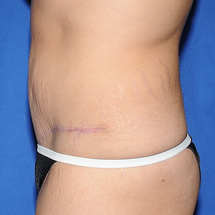 Abdominoplasty Before & After