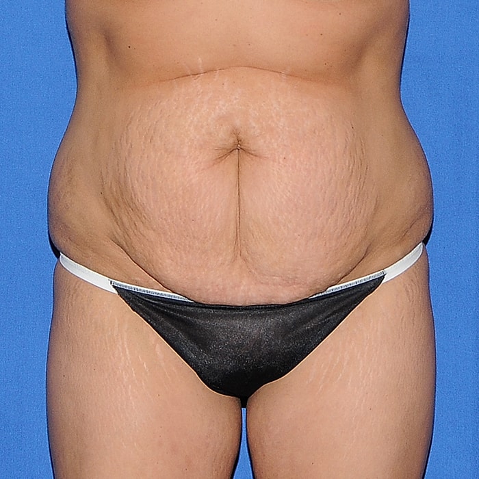 Abdominoplasty Before & After