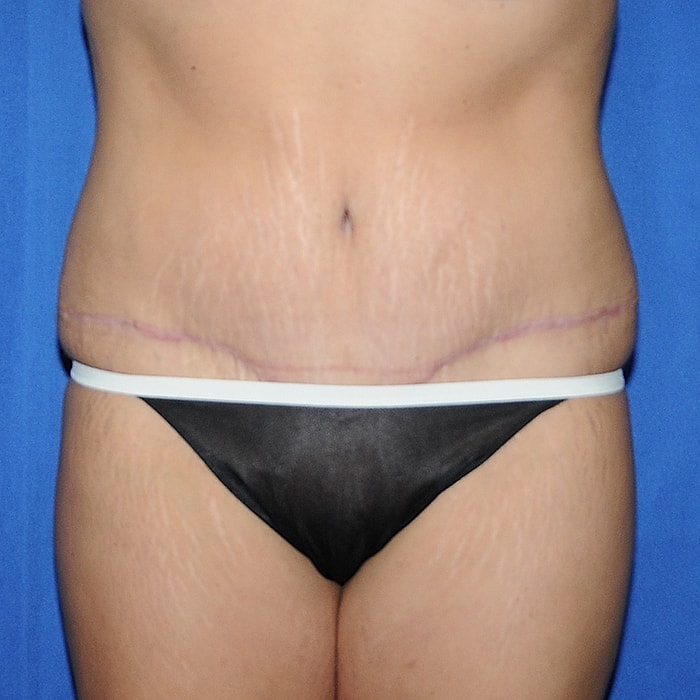 Abdominoplasty Before & After