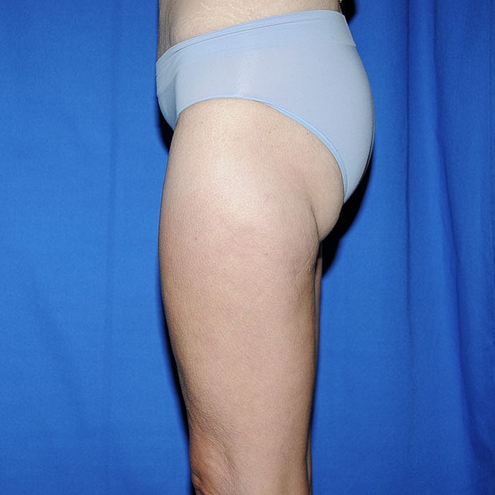 Thigh Lift Body Lift Massive Weight Loss Before & After