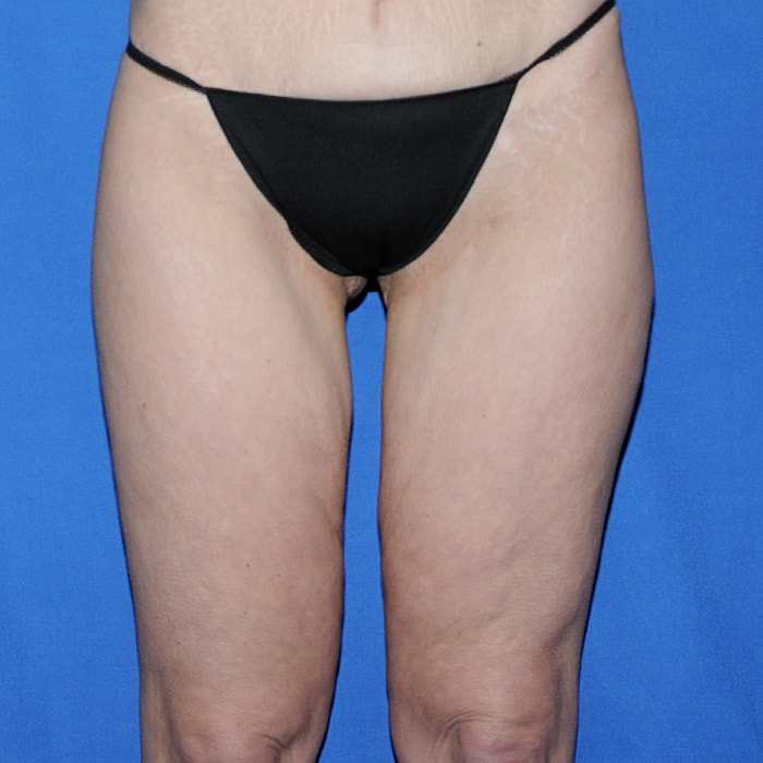 Thigh Lift Body Lift Massive Weight Loss Before & After