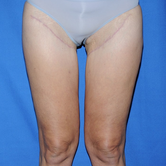 Thigh Lift Body Lift Massive Weight Loss Before & After