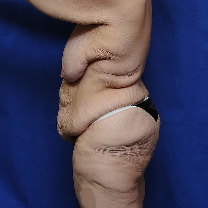 Thigh Lift Body Lift Massive Weight Loss Before & After