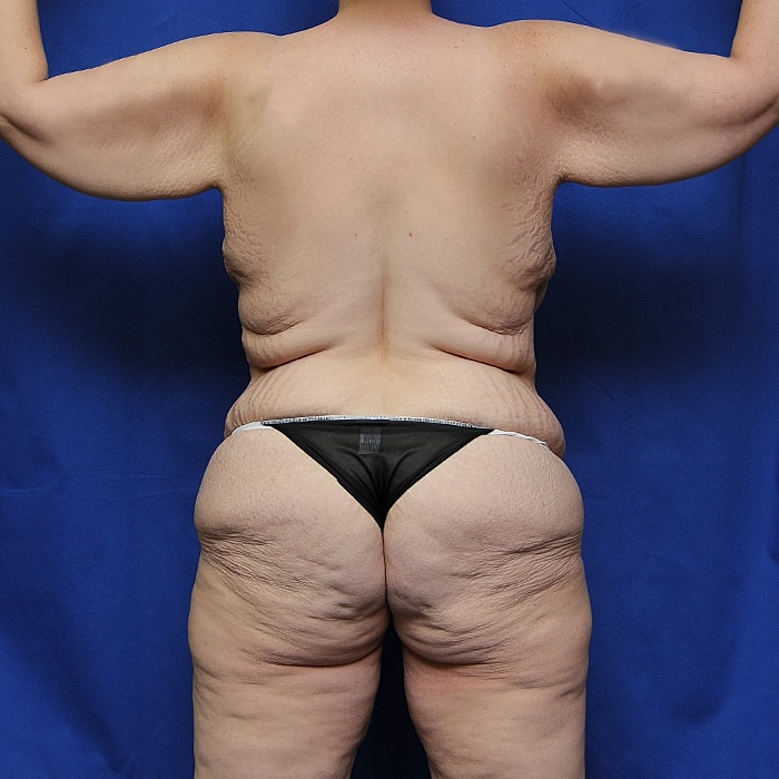 Thigh Lift Body Lift Massive Weight Loss Before & After