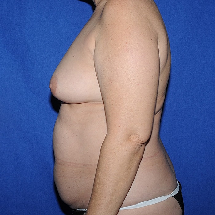 Bilateral DIEP 3d Nipple Tattoo Before & After