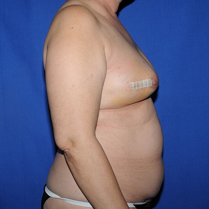 Bilateral DIEP 3d Nipple Tattoo Before & After