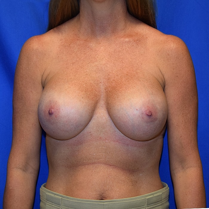 Breast Implant Exchange Before & After