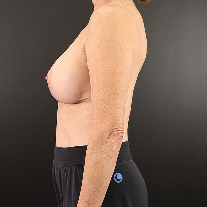 Breast Implant Exchange With Mastopexy Before & After