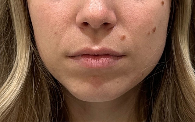 Close-up of lips and chin, natural skin texture.