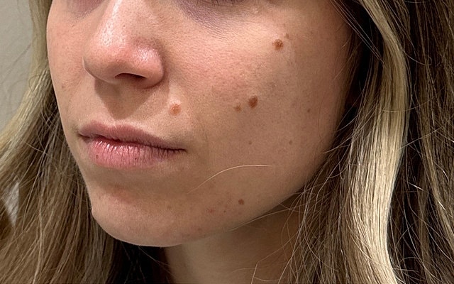Close-up of woman's face with moles.